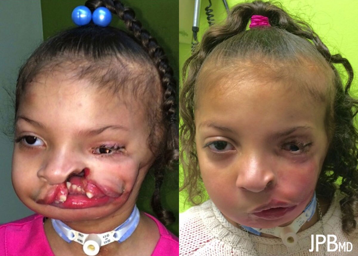Craniofacial Surgery - Before and After Photo Performed by James P. Bradley, MD in New York City