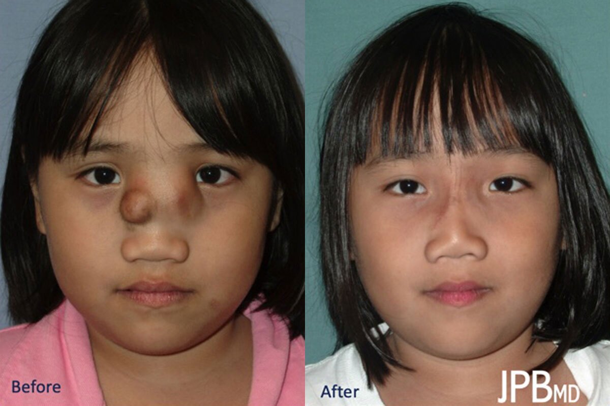 Craniofacial Surgery - Before and After Photo Performed by James P. Bradley, MD in New York City