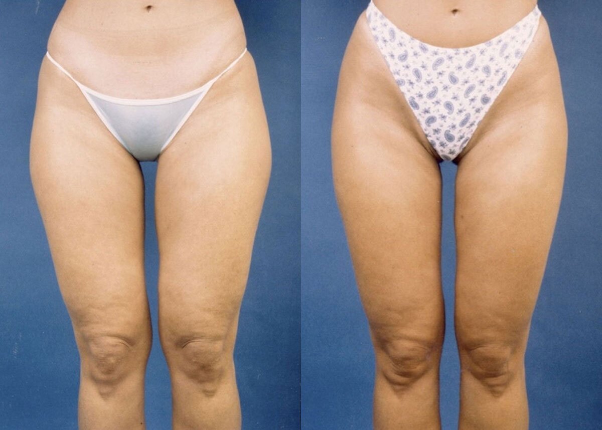 Liposuction - Before and After Photo Performed by James P. Bradley, MD in New York City