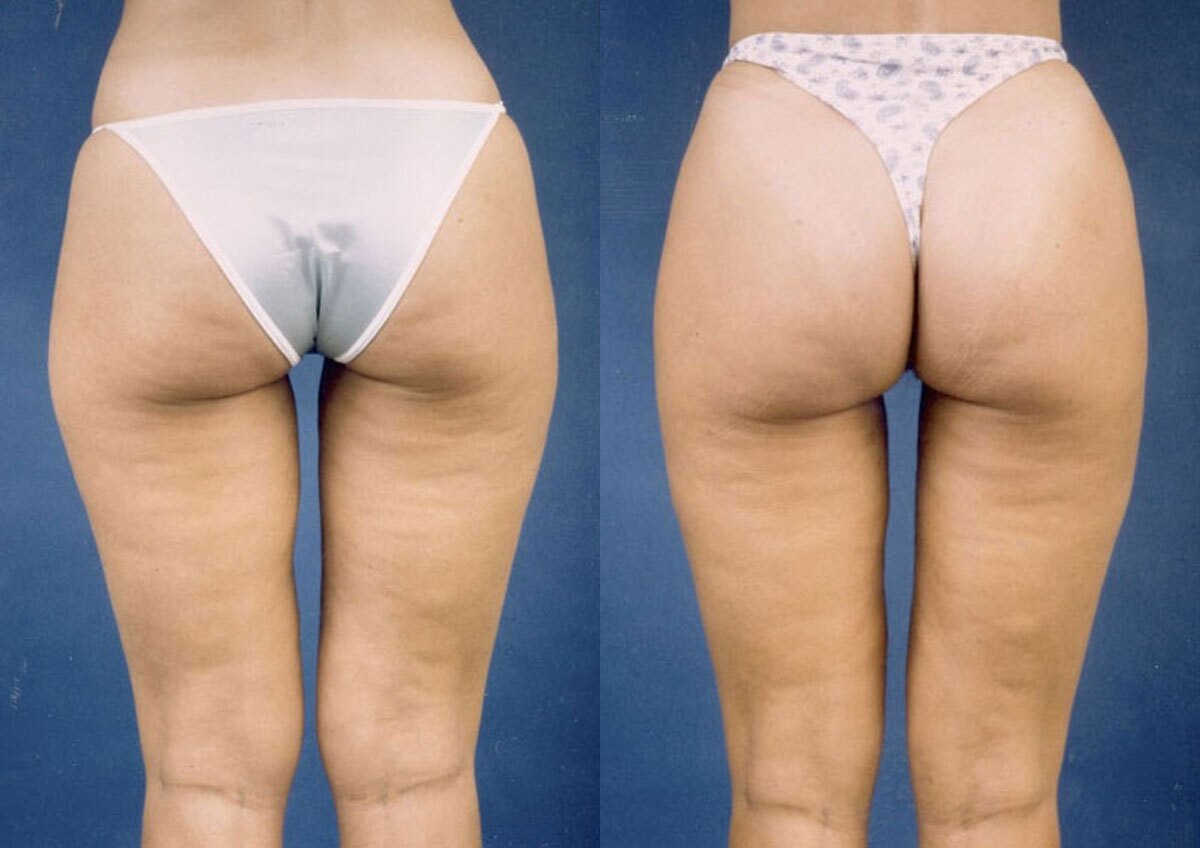 Liposuction - Before and After Photo Performed by James P. Bradley, MD in New York City