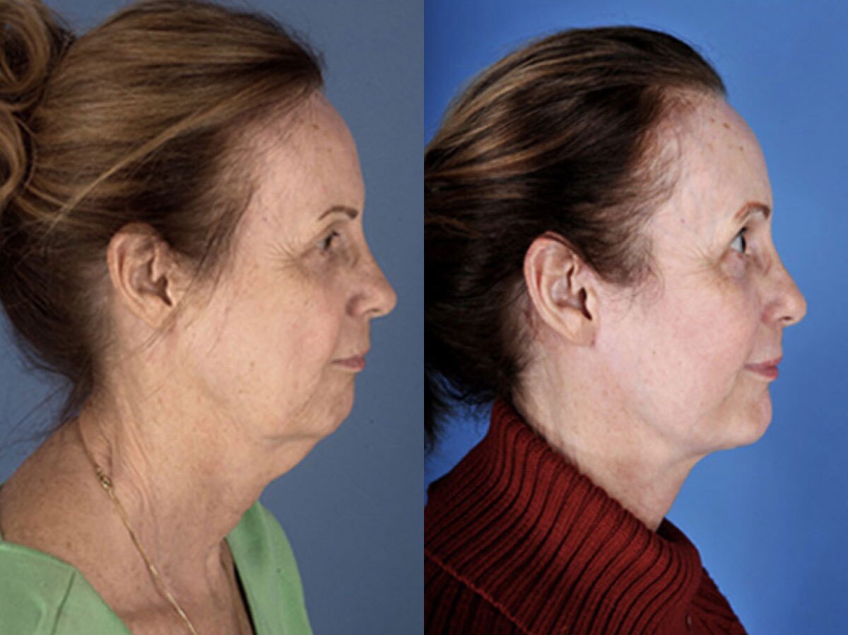 Beautiful lady with loose skin on her neck and the lady after Neck Lift, New York NY