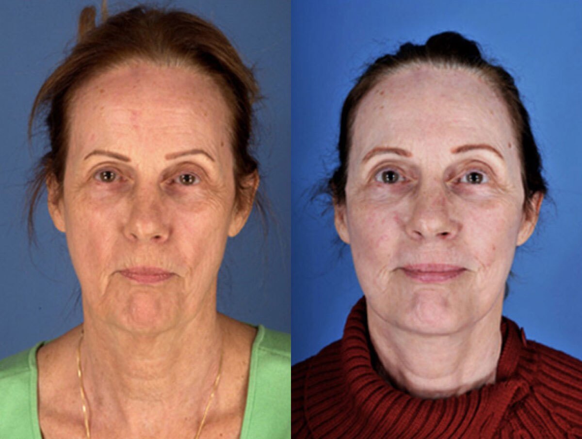 Beautiful lady with loose skin on her neck and the lady after Neck Lift, New York NY