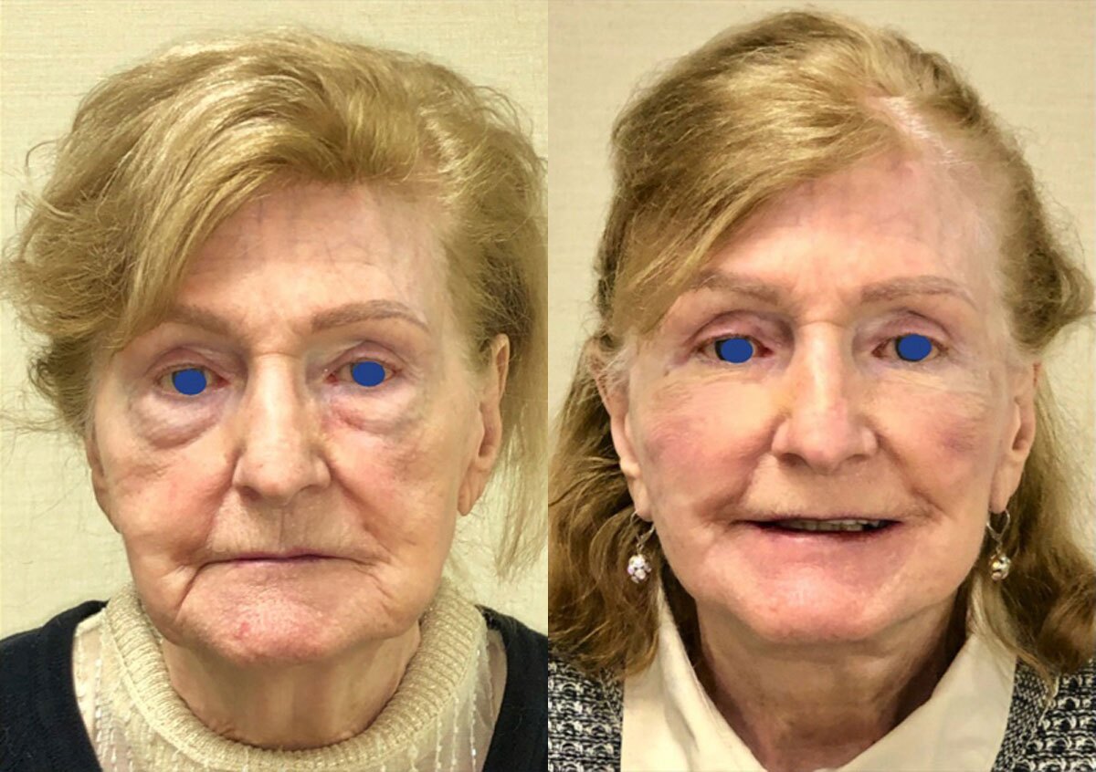 Beautiful Lady with lose skin on her neck and lady after Neck Lift, New York NY