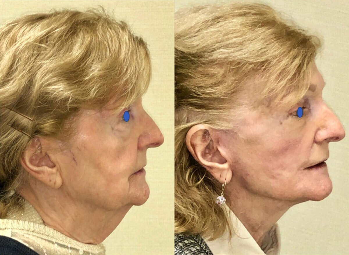 Beautiful lady with loose skin on her neck and lady after Neck Lift, New York NY