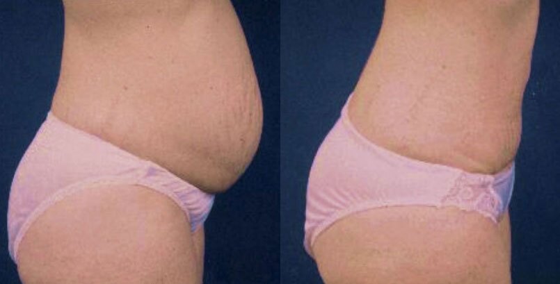 Before & After Photo - Abdominoplasty - James P Bradley, MD