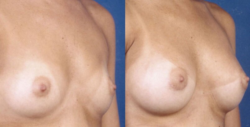 Before & After Photo -Breast Augmentation - James P Bradley, MD