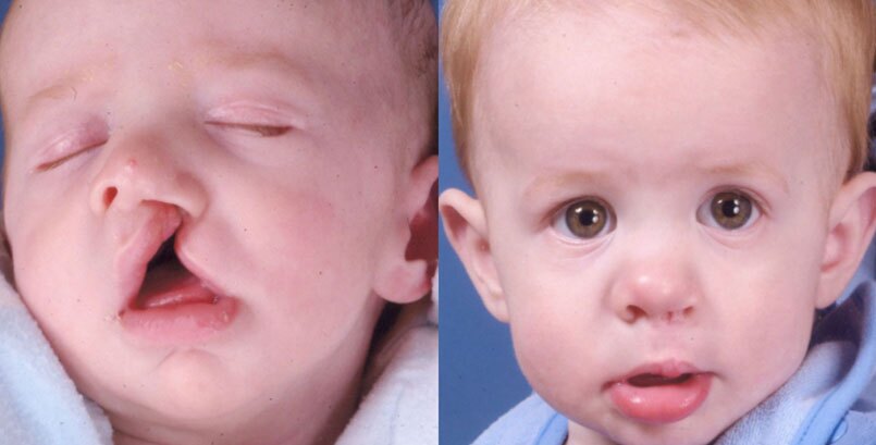 Before & After Photo - Cleft Lip - James P Bradley, MD