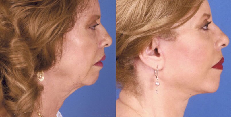 Before & After Photo - Facelift - James P Bradley, MD