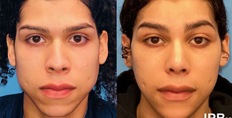 Before & After Photo - Facial Feminization - James P Bradley, MD