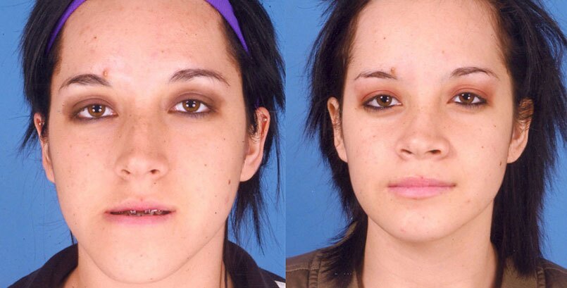 Before & After Photo -Jaw Surgery - James P Bradley, MD