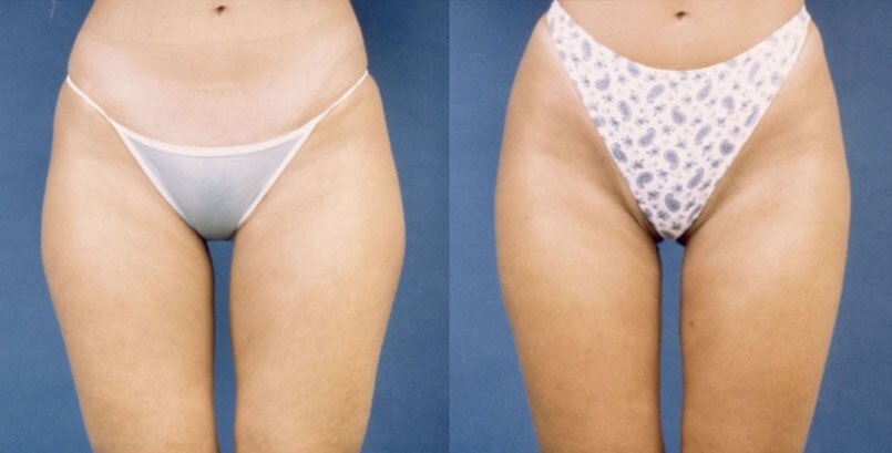 Before & After Photo -Liposuction - James P Bradley, MD