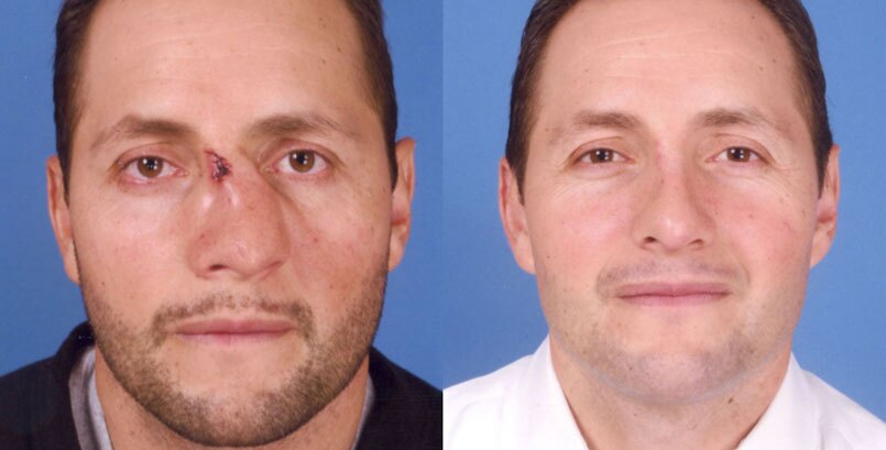 Before & After Photo - Rhinoplasty - James P Bradley, MD